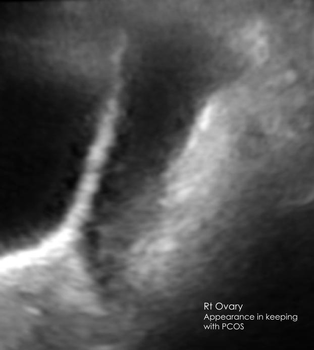 Right ovary appearance consistent with PCOS